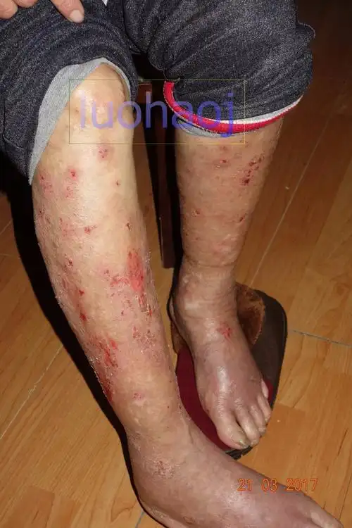 下肢顽固性湿疹伴溃疡案例 - 好大夫在线