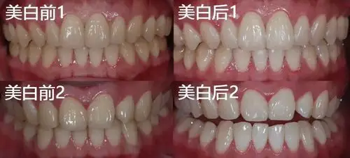 上饶口腔医院——皓齿美白效果展示:(除此之外还有一个大礼)活动参与