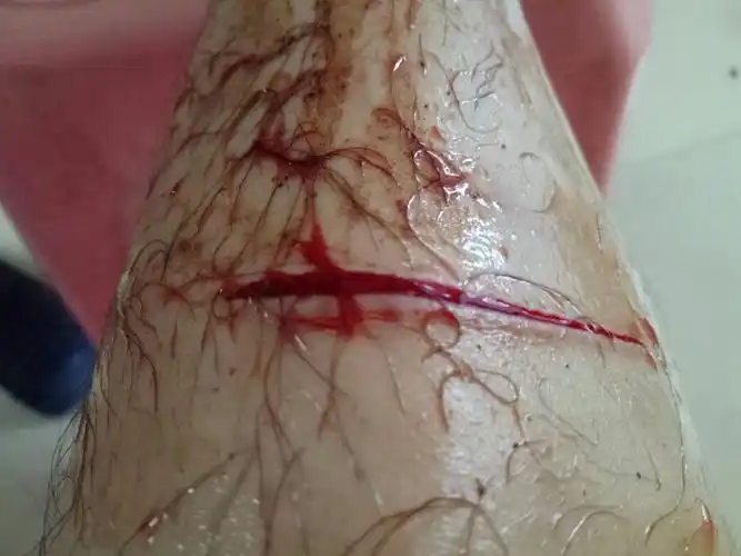 本人是做五金冲压生产的,昨晚不小心被不锈钢材料划了下,伤口不乐观,