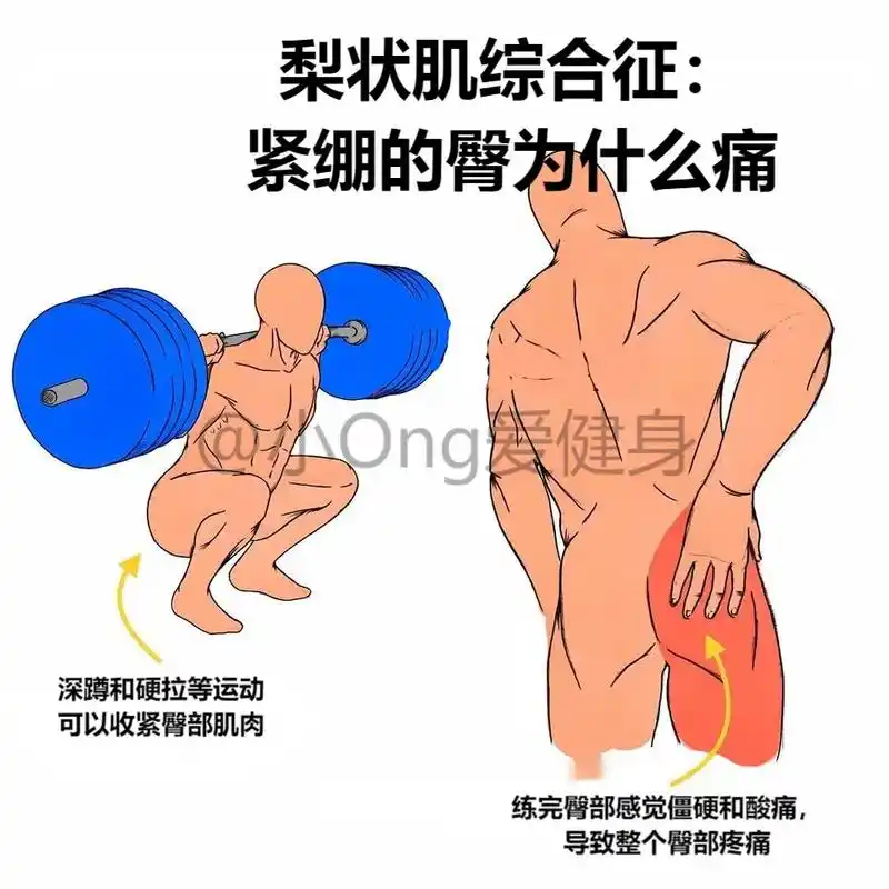每天一条干货!久坐/紧张的臀部为什么会疼.