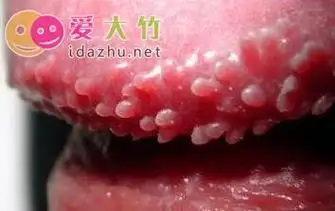 得了尖锐湿 疣都有哪些症状?