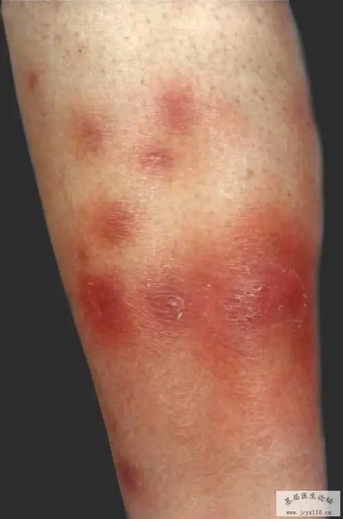 部分皮肤病图片