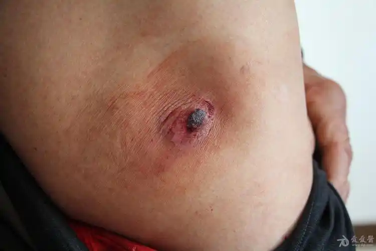 典型病例化脓性肉芽肿