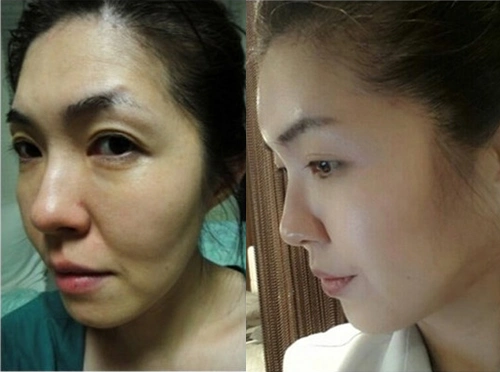 巴诺巴奇面部脂肪填充案例对比