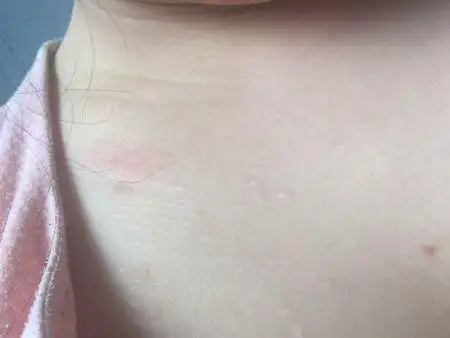 胸前出来这种白色的稍微凸起的东西 是什么呀 有点像痘印