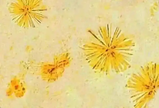 尿液中常见的盐类结晶