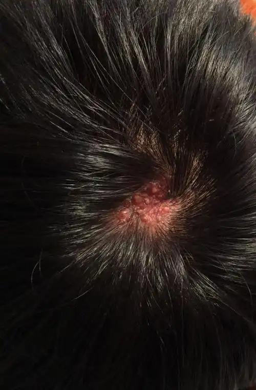 我今年18岁,头上有块疤,父母说是天生的,我想知道