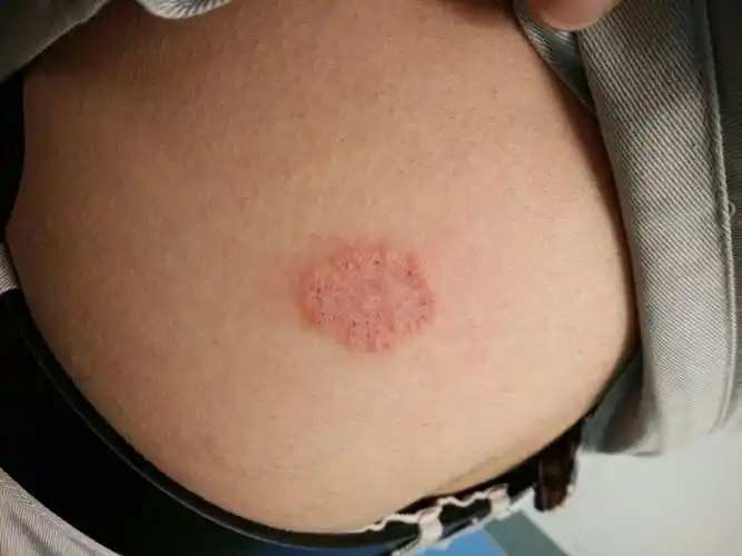 一个多星期了,在腰左边,不痛不痒的,偶尔有点刺挠,也没去看,左边图片