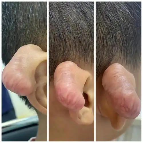 形成了一个肉疙瘩像一大朵菌子家长看着着急来到第二附属医院进行治疗