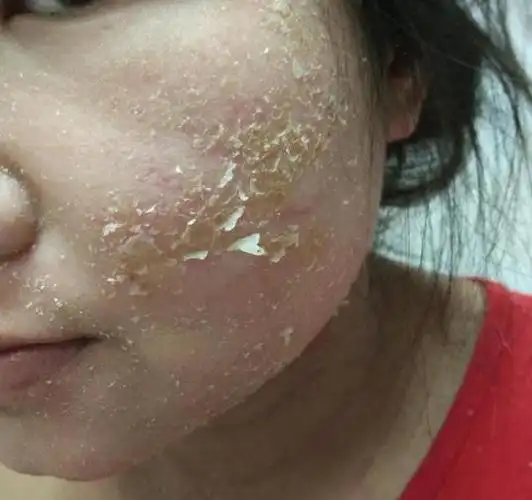 激素依赖性皮炎的症状是:红,肿,热,痛,痒,干燥,脱皮,流黄水,结痂,起小