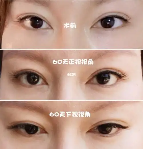 关于眼睑下至术的一些问题六年经验分享