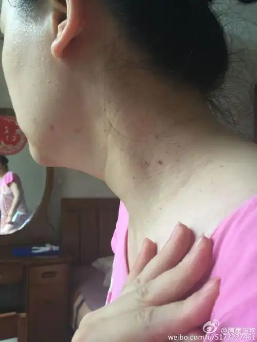 脖子上丝状疣根治方法# #浓缩型东方妙水#. 来自德康生物 - 微博