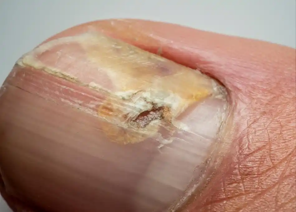 体内有癌,指甲先知?指甲出现6种异常,或是患病信号