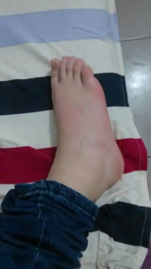 摔了一跤,这脚有事吗