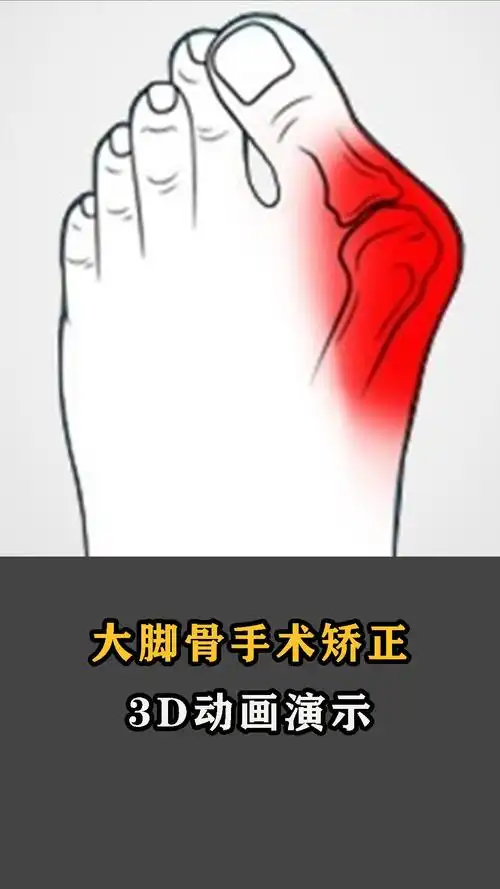 大脚骨矫正手术过程动画演示