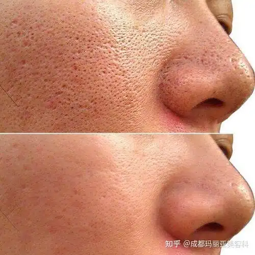 男生脸部毛孔粗大该如何改善