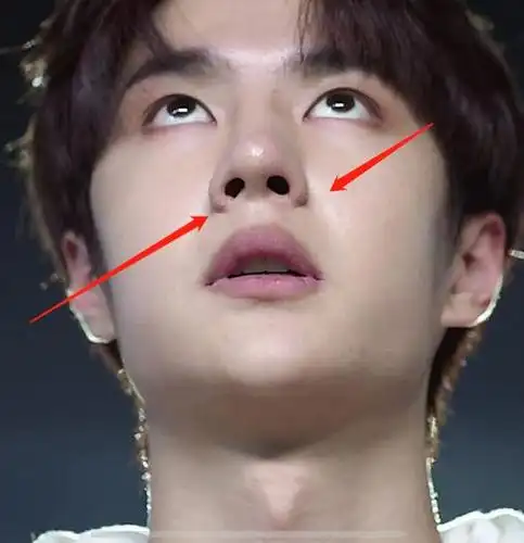 继缩鼻翼之后,王一博生图再现"整容痕迹"?网友:假体太明显了