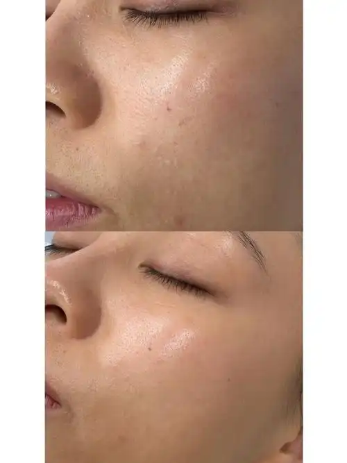 光子嫩肤|年龄过了25以后开始出现毛孔粗大松弛,红血丝泛滥,色素沉淀