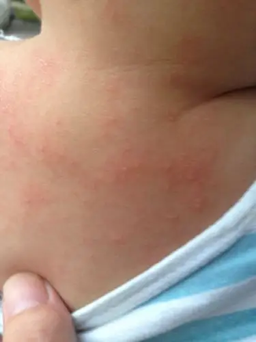 痱子介绍_痱子病因_痱子治疗_痱子医院医生_有来医生