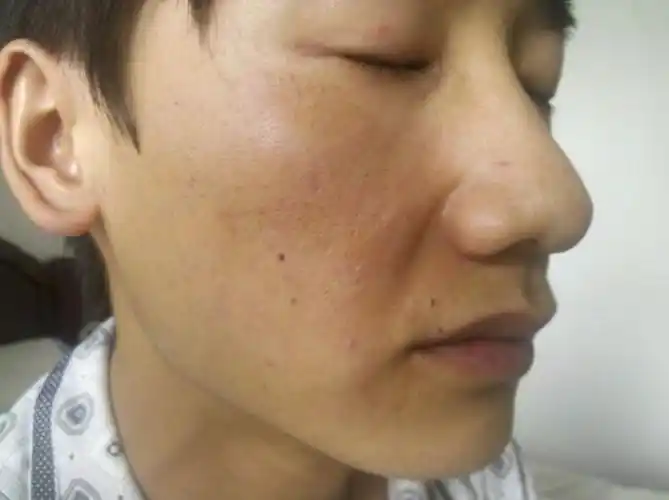 新生儿皮肤发黄