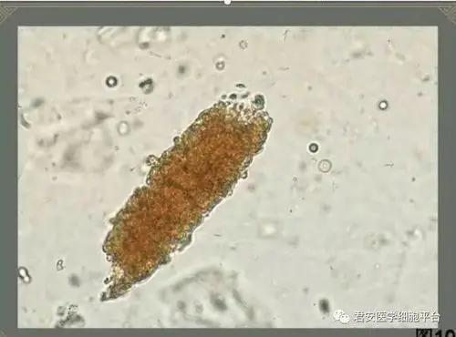 血液管型红细胞管型:其内红细胞形态完整清晰,形态可正常或异常,其