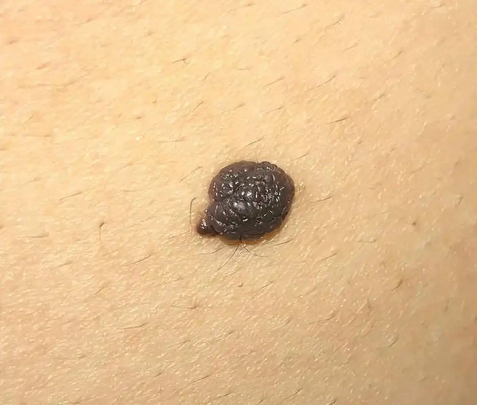 医生提醒:若黑痣长在这4个部位,要密切关注,及早做检查