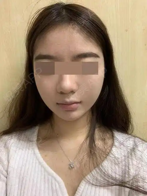 自体脂肪面部填充半个月了,面部状态恢复非常的好,面.