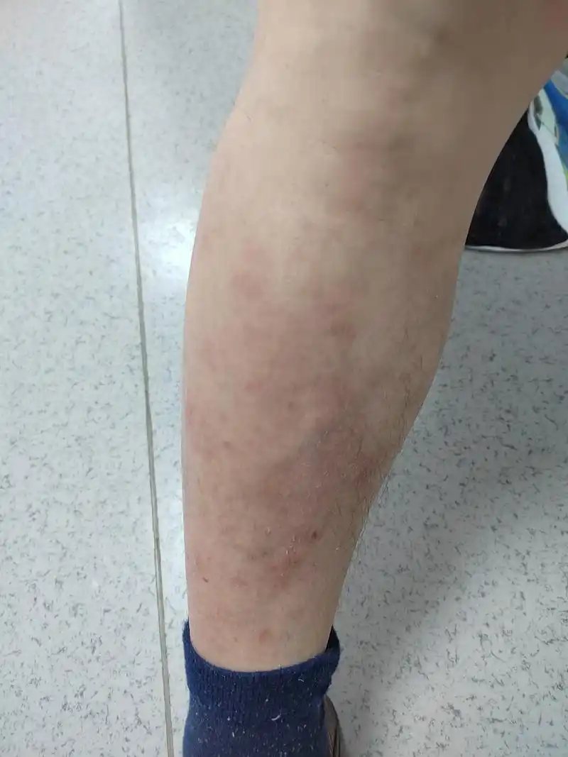 小腿部位的特应性皮炎症状使用生物制剂治疗后皮炎症状消退很快#解决