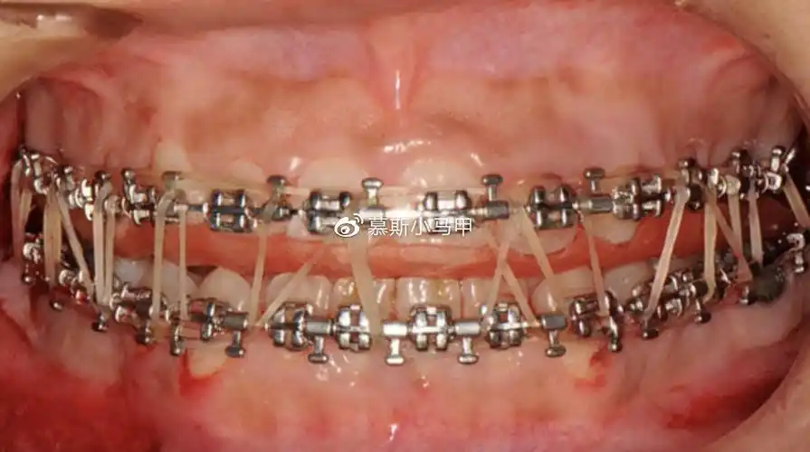 颧骨内推需要用到钛钉固定,那么术后需要取出来吗?取掉后会松弛吗?