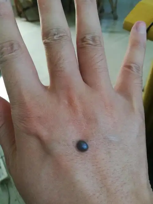 手背黑痣变大