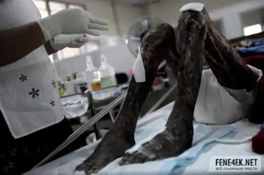 全身溃烂的艾滋病晚期患者