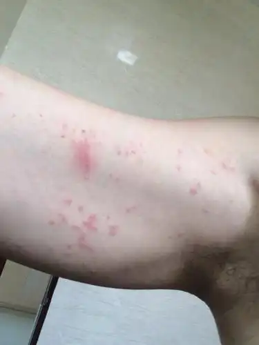 身上长了很多一粒粒的红疹子,有的一颗颗分散的,有