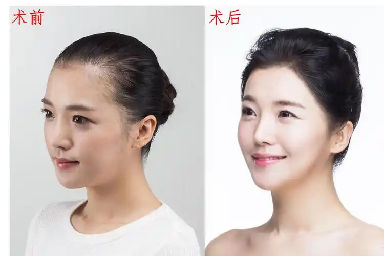 进阶女神你的发际线合格了吗