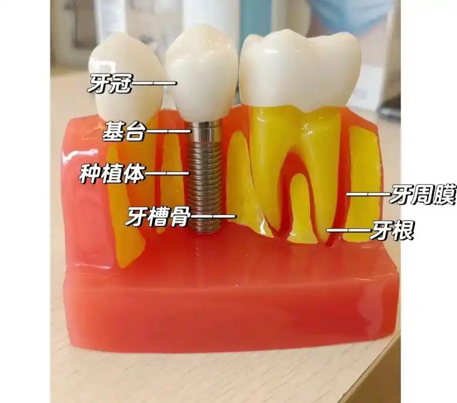 种植牙完整流程图.