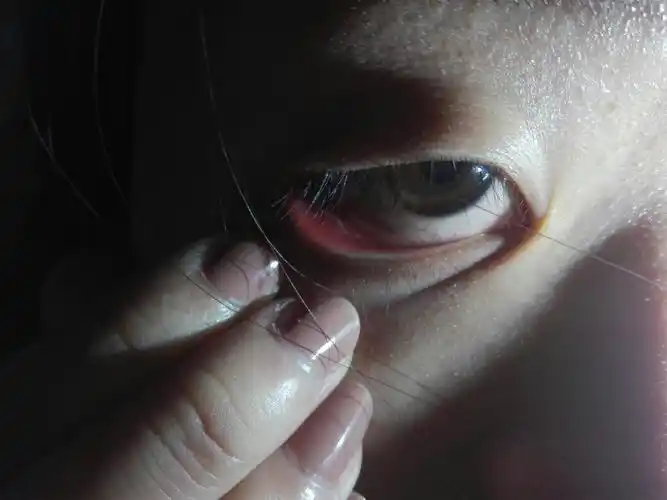 室友眼睛下眼皮发红 还有白色的东西 大神帮看看这是怎么了