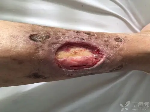 右小腿胫前皮肤缺损如何选择合适的治疗方案?