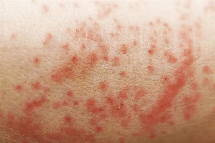 手臂上有很多小红点是什么原因手臂上无缘无故出现小红点