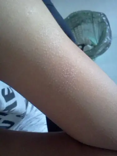 手臂上就一块地方像鸡皮肤和疹子一样的,还脱皮 什么情况