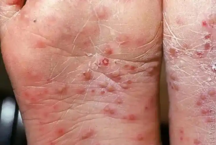 手足口病防治知识 __海口市秀英区长流镇中心幼儿园