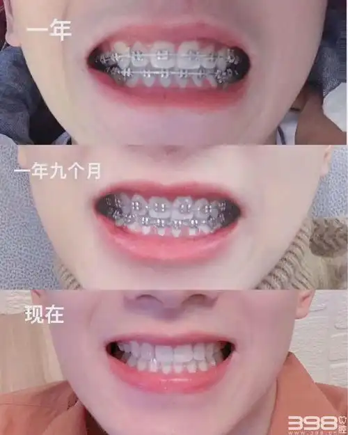 广州男孩金属牙齿矫正前后对比令人出乎意料