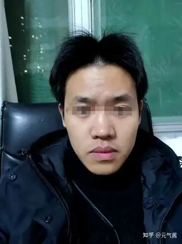 男生做隆鼻肋骨鼻综合是什么样的体验塌鼻子男生的逆袭