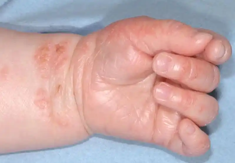 一般出现在哪里?皮炎湿疹是一种皮肤病 - 抖音