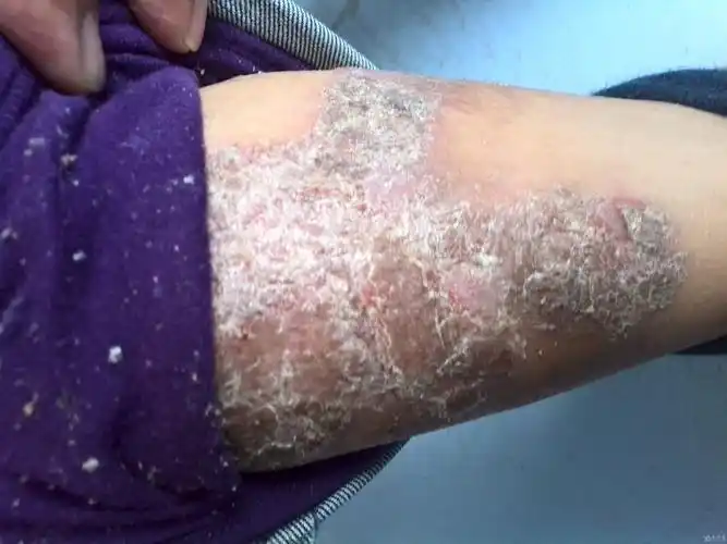 楼主lchlhltt3天前牛,,,皮,,,癣.