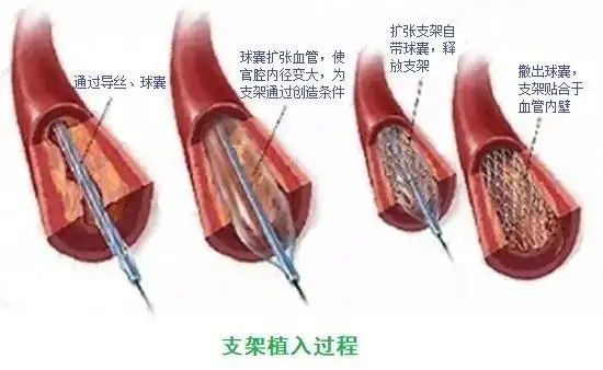 安装了心脏支架是不是人就废了? - 好大夫在线