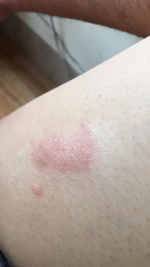 请问这是什么皮肤病呢?