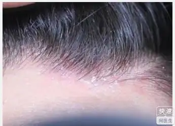 头皮脂溢性皮炎有哪些症状