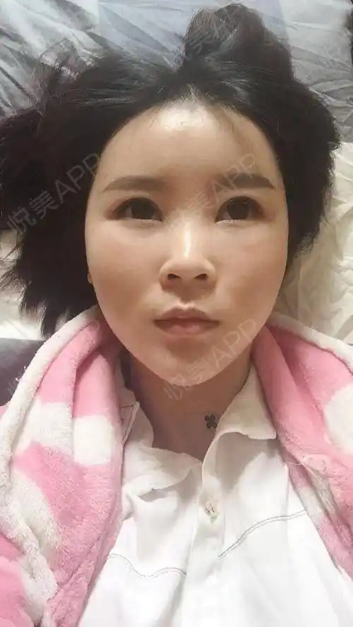 【南京美贝尔整形医院-自体脂肪全脸填充】我的五官其实跟很多人比不