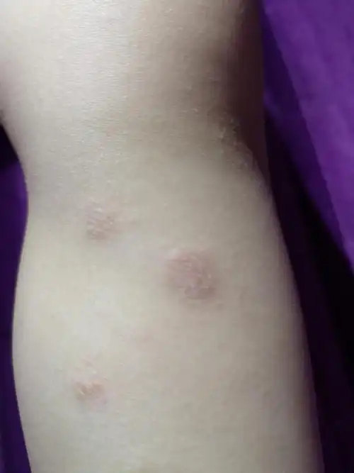 腿上起的什么东西,不痒痒 为您推荐: 其他回答 看起来比较像铜钱癣