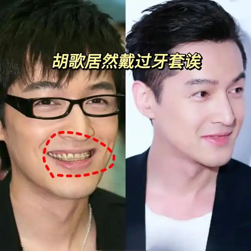 胡歌#牙齿#牙套 #牙齿矫正 - 抖音