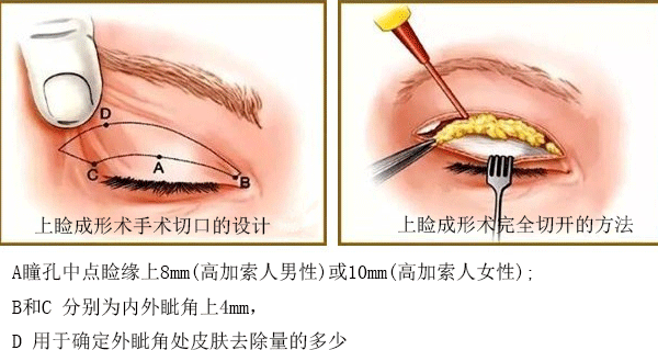 上睑下垂最严重的是什么样的(看图识术图解上下睑形成术)(3)